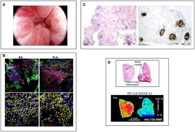 Psoriatic Synovitis: Singularity and Potential Clinical Implications